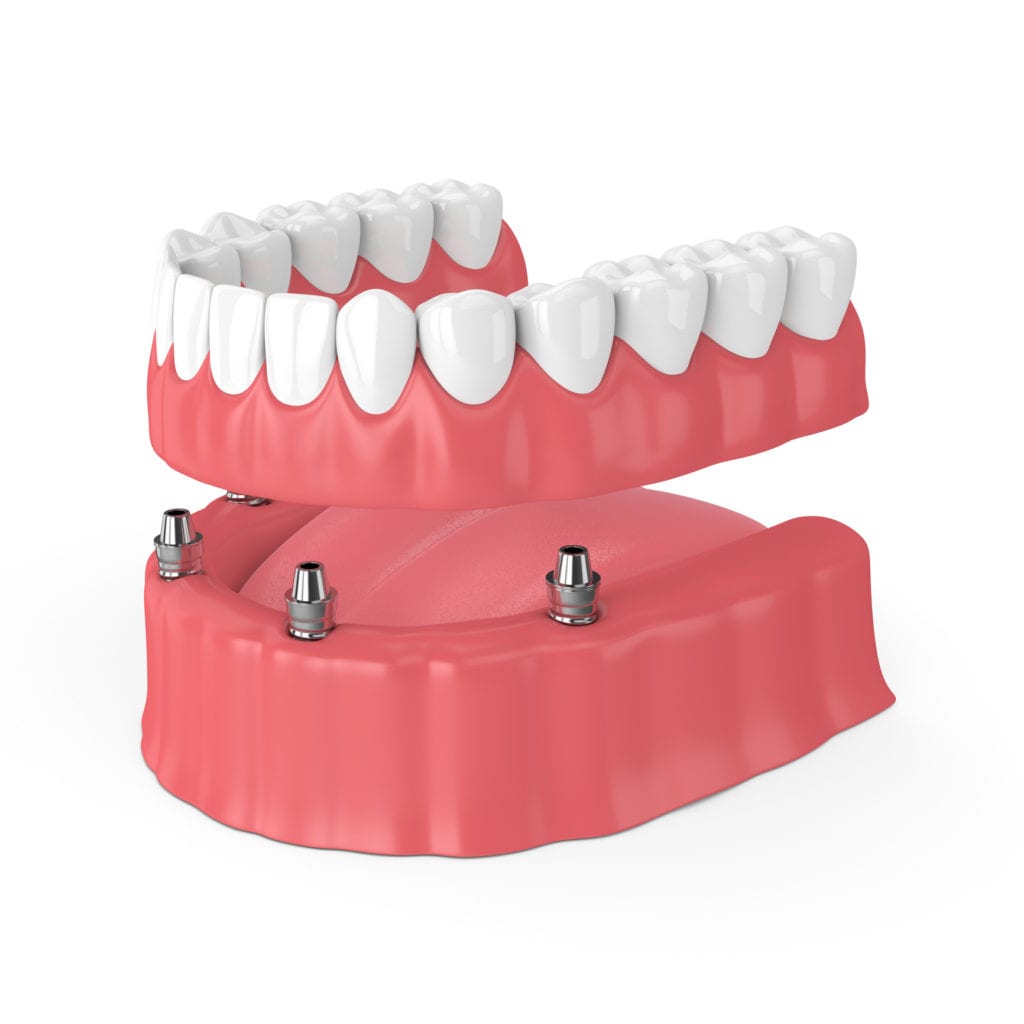 20++ Affordable dentures baton rouge information